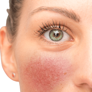 couperose peau UV 31 Sun Détente toulouse